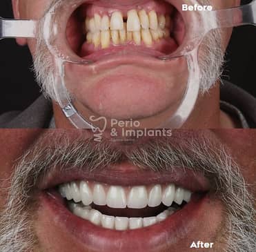 Slider image (6) Perio & Implants Tijuana